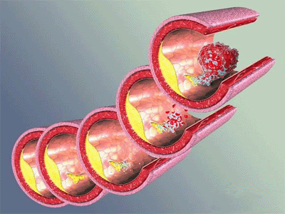 血脂代谢物早期鉴别心血管疾病